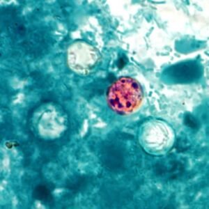 Cyclospora Outbreak Spreads Across US, Produce Implicated